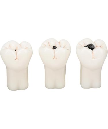 4-Fold Dental Caries Model - Synthetic Resin Oral Care Training Tool for Students | Safe & Realistic Simulation - Buy Online on SooperMarket.com