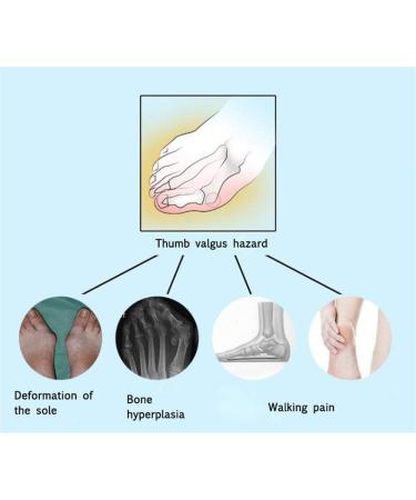 JHGCCL Thumb Eversion Bunion Corrector Night Use 1 Pair - Toe Separators for Overlapping Toes - Buy Online on SooperMarket.com