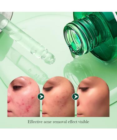 Tea Tree Oil for Face - Acne Serum & Blemish Spot Treatment - Unclogs Pores Soothes Breakouts - 1 fl oz for Smooth Glowing Skin - Buy Online on SooperMarket.com