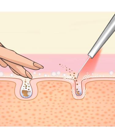 Lumineo Ultrasound Peeling Device - 4-in-1 Skin Scrubber Blackhead Remover EMS LED & Ions with 400ml Moisturizing Toner | Best Acne & Pore Cleaner - Buy Online on SooperMarket.com