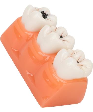 4-Fold Dental Caries Model - Synthetic Resin Oral Care Training Tool for Students | Safe & Realistic Simulation - Buy Online on SooperMarket.com