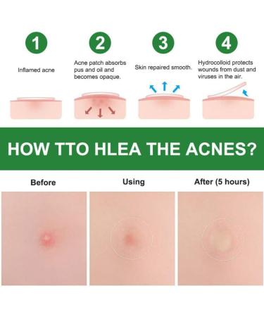 Acne Healing Patch Acne Absorbing Cover Invisible Skin Acne Treatment Stickers for Facial 24Patches acne treatment - Buy Online on SooperMarket.com