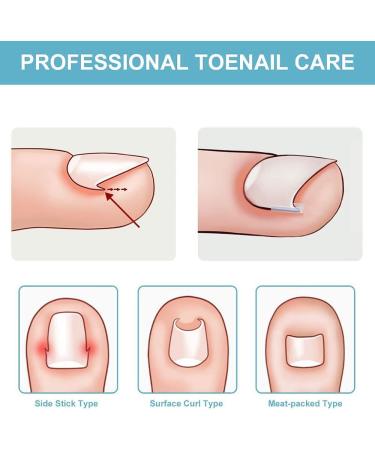 Ingrown Toenail Correction Patch Ingrown Correction Sticker 46 Pieces Ingrown Toenail Correction Patch Care Ingrown Nail Patch for Men Women - Buy Online on SooperMarket.com