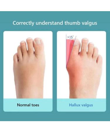 Kenanlan Bunion Corrector for Women - 2PC Toe Splints & Separators for Overlapping Big Toe - Universal Size - Buy Online on SooperMarket.com