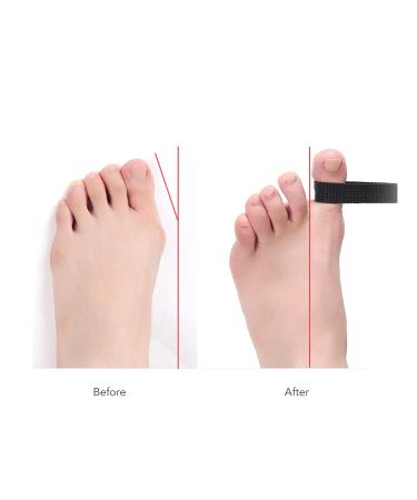 ANGGREK Bunion Toe Straightener - Corrector Splint for Big Toe Alignment, Relief Fatigue, Flexibility Training & Stretcher - Buy Online on SooperMarket.com