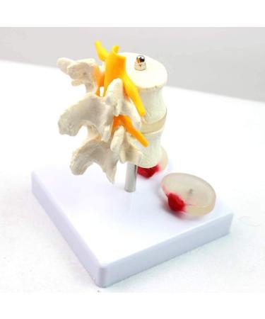 Model of Human Spine Detachable Medical Teaching Model Lumbar Spine Injuries with 2 Intervertebral Disc Model Model - Buy Online on SooperMarket.com