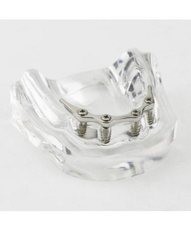 Dental Restore Model with 4 implants implant Demonstration Lower Precision Model Dental Teeth Restoration semi-Covered Prosthesis Decoration - Buy Online on SooperMarket.com