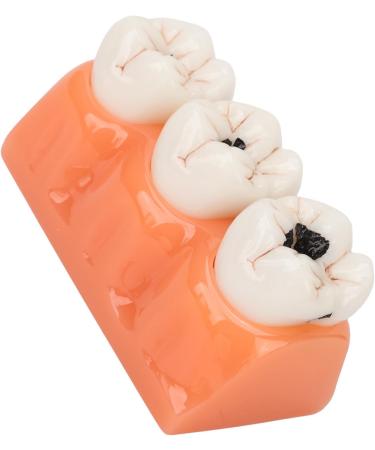 4-Fold Dental Caries Model - Synthetic Resin Oral Care Training Tool for Students | Safe & Realistic Simulation - Buy Online on SooperMarket.com