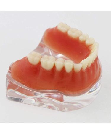 Dental Restore Model with 4 implants implant Demonstration Lower Precision Model Dental Teeth Restoration semi-Covered Prosthesis Decoration - Buy Online on SooperMarket.com