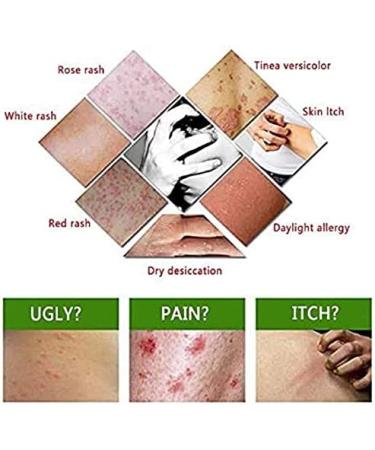 6PCS Chinese Herbal Eczema Psoriasis Creams for Dermatitis & Pruritus - CEZUBEM Ointment - Buy Online on SooperMarket.com