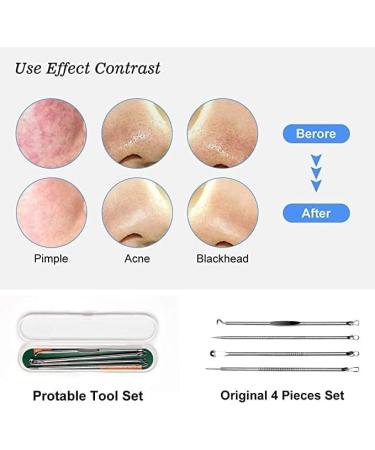 4PCS Blackhead Remover Tool Set for Acne, Comedone, Pimples, Spot, and Zit Extraction - Buy Online on SooperMarket.com