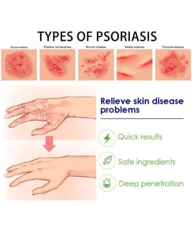 Eczema & Psoriasis Cream - Natural Relief for Dry, Itchy Skin | Scalp Rash Redness Acne - Buy Online on SooperMarket.com