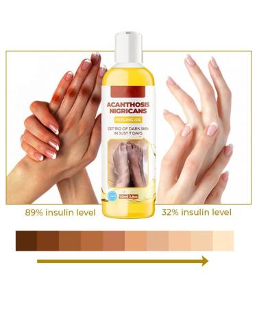 Extra Strong Peeling Oil - Chemical Exfoliant for Face & Body | Reduces Wrinkles Stretch Marks & Dead Skin - Buy Online on SooperMarket.com