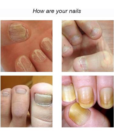 7 Days Nail Growth and Strengthening Serum 1/2/3/5 bottles Nail Strengthener and Growth Serum (3 bottles) - Buy Online on SooperMarket.com