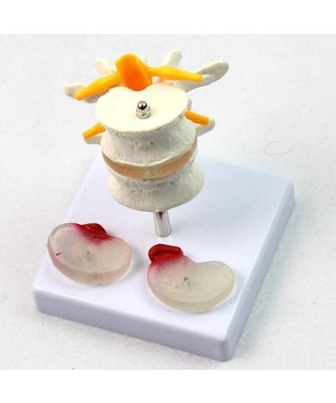 Model of Human Spine Detachable Medical Teaching Model Lumbar Spine Injuries with 2 Intervertebral Disc Model Model - Buy Online on SooperMarket.com