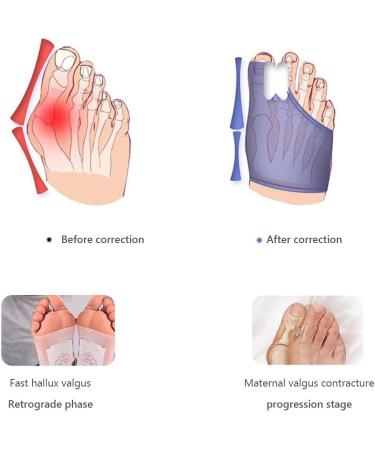 Kenanlan Bunion Corrector for Women - 2PC Toe Splints & Separators for Overlapping Big Toe - Universal Size - Buy Online on SooperMarket.com