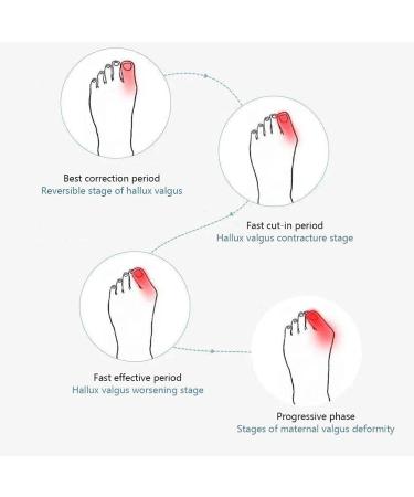 Kenanlan Bunion Corrector for Women - 2PC Toe Splints & Separators for Overlapping Big Toe - Universal Size - Buy Online on SooperMarket.com