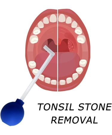 Tonsil Stone Remover Tool - Manual Style Mouth Cleaning Care Tool - Ear Wax Cleaning Tool - Pink - Buy Online on SooperMarket.com