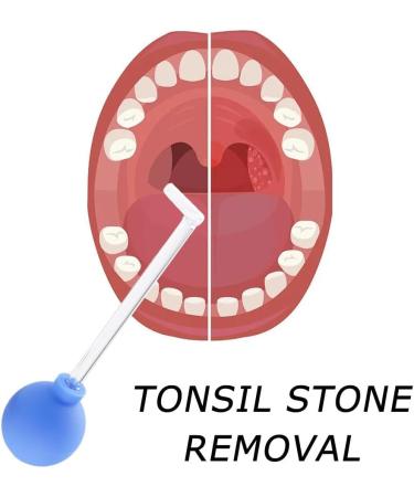 Manual Tonsil Stone Remover Tool for Adults | Mouth Cleaning Care & Ear Wax Removal | 1pcs Green - Buy Online on SooperMarket.com