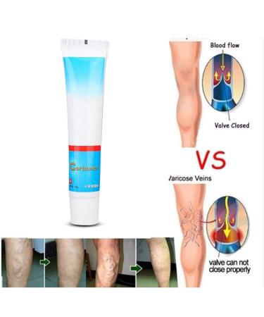 Varicose Vein Treatment Cream - Reduce Inflammation, Improve Circulation | Vein Lotion for Legs & Body - Buy Online on SooperMarket.com