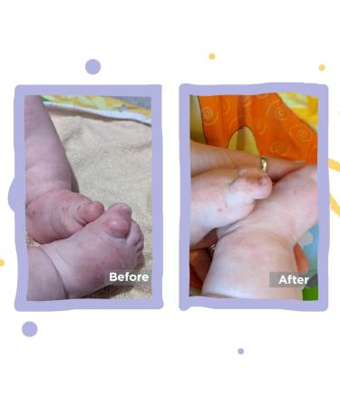 Eczema Baby Leggings | Moisturizing Skin Relief | for Babies 18-24 Months | White - Buy Online on SooperMarket.com