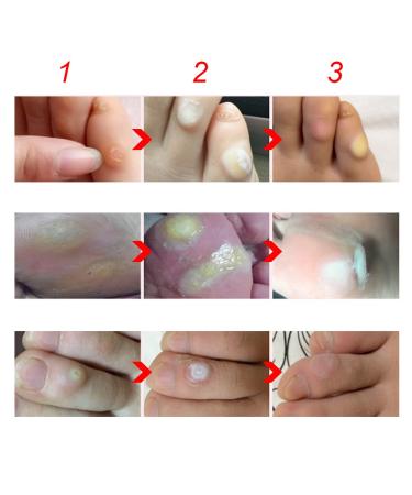 Foot Corn Plaster 10ml - Callus & Corn Removal Cream for Pain Relief - Buy Online on SooperMarket.com