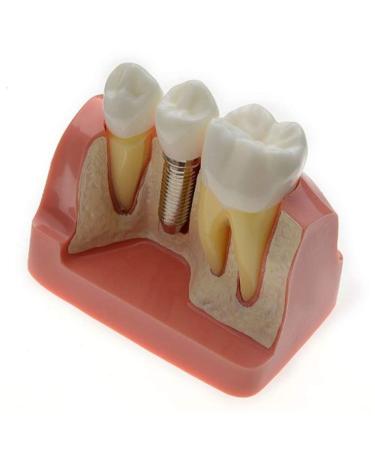 Dental Implant Analysis Demonstration Model - Crown Bridge Teeth Interpretation Model - Buy Online on SooperMarket.com
