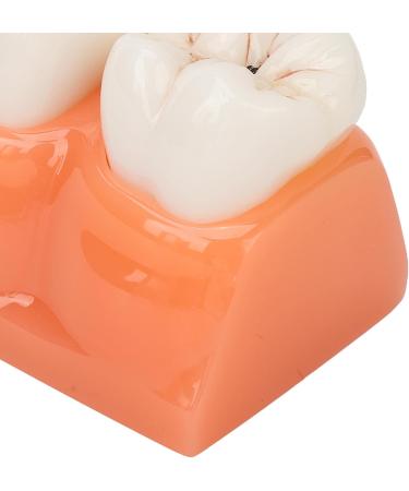 4-Fold Dental Caries Model - Synthetic Resin Oral Care Training Tool for Students | Safe & Realistic Simulation - Buy Online on SooperMarket.com