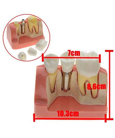 Dental Implant Analysis Demonstration Model - Crown Bridge Teeth Interpretation Model - Buy Online on SooperMarket.com