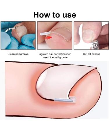 KARELLS Ingrown Toenail Correction Set Ingrown Toenails Set 12 Pieces Ingrown Toenail Lifter Ingrown Toenail Correction Treatment Set for Ingrown Toenails - Buy Online on SooperMarket.com
