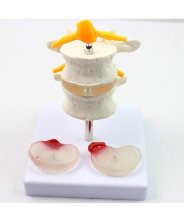Model of Human Spine Detachable Medical Teaching Model Lumbar Spine Injuries with 2 Intervertebral Disc Model Model - Buy Online on SooperMarket.com