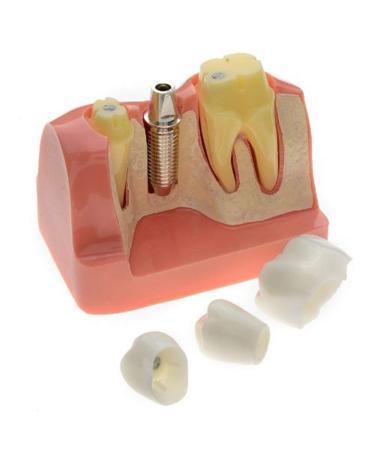 Dental Implant Analysis Demonstration Model - Crown Bridge Teeth Interpretation Model - Buy Online on SooperMarket.com