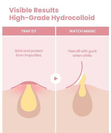 Glam Up Hydrocolloid Blemish Pimple Zit Patches - 72 Count, Invisible Ultra-Thin Spot Cover Stickers for Face, Strong Water-Proof, Vegan-Friendly - Buy Online on SooperMarket.com