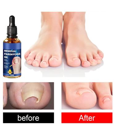 3Pcs German Toenailcare Removal Paronychia Oil for Healthier Toenails - Buy Online on SooperMarket.com