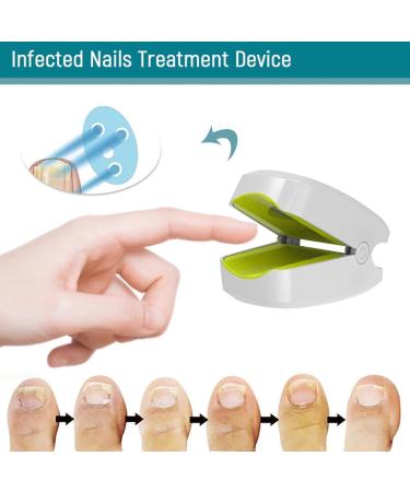 Lanlousy 905NM Nail Therapeutic Instrument Portable Painless Nail Therapy Device Anti- Silicone Easy to Use White - Buy Online on SooperMarket.com