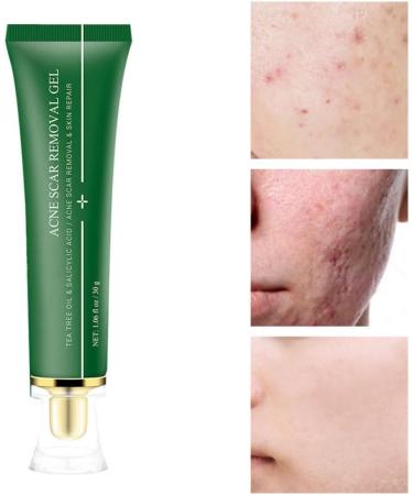 Acne Scar Removal Gel Face Body Marks Skin Repair Cream Acne Treatment Essence 30g acne removal cream - Buy Online on SooperMarket.com