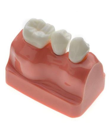 Dental Implant Analysis Demonstration Model - Crown Bridge Teeth Interpretation Model - Buy Online on SooperMarket.com