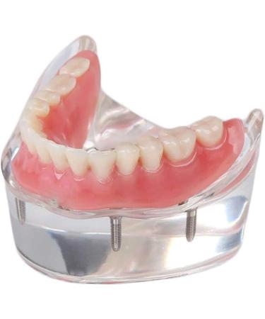 Dental Restore Model with 4 implants implant Demonstration Lower Precision Model Dental Teeth Restoration semi-Covered Prosthesis Decoration - Buy Online on SooperMarket.com