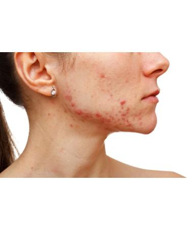 Thursday Plantation Tea Tree Medicated Gel for Acne 25g - Targeted Treatment for Clear Skin - Buy Online on SooperMarket.com