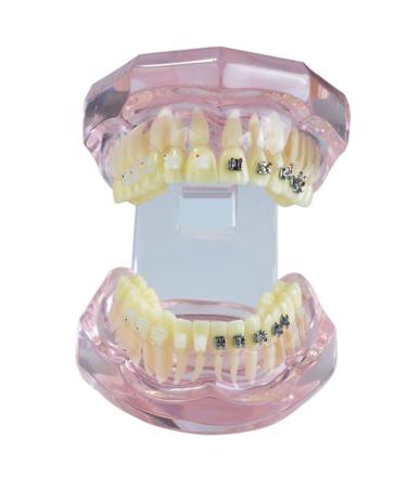 LBYLYH orthodontic demonstration model teeth teach study tools with metal and ceramic support for orthodontic dental treatment