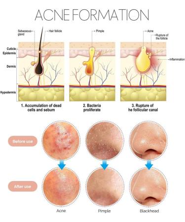 Teenitor 7 in 1 Pimple Blackhead Remover Extractor Tool Kit - Professional Acne Treatment for Nose and Face Skin - Buy Online on SooperMarket.com