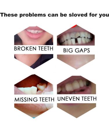 Snap on Smile Braces Instant Perfect Smile Temporary Replacement Tooth Kit for Broken Missing Teeth - Buy Online on SooperMarket.com