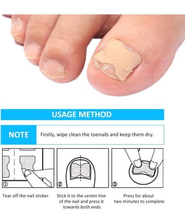 Toenail Patch Ingrown Toenail Toenail Correction Toenail Correction Patch Toenail Correction Patch Ingrown Toenail Nail Care 50 Pieces - Buy Online on SooperMarket.com