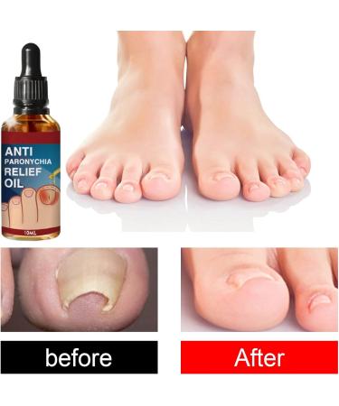 Ingrown Toenail Treatment Correction Drops Nail Growth Treatment Nail Care Ingrowing Toenail Treatment Ingrown Toenail Corrector Treatment for Ingrown Toenail Ingrowing Toenail Improve Toenail Health - Buy Online on SooperMarket.com