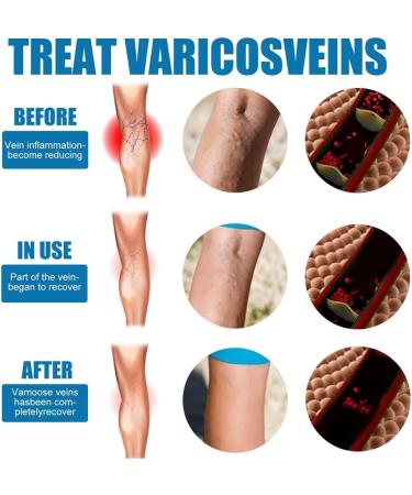 3 Pieces VeinHealing Varicose Vein Spray - Remove Varicose & Spider Veins Soothing Treatment for Legs 30ml | Improve Blood Circulation - Buy Online on SooperMarket.com