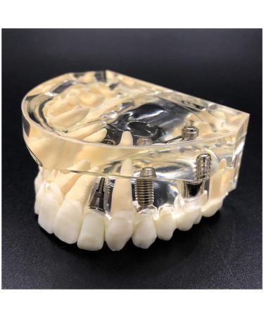 Implant Tooth Template Oral Simulation Dental Tooth Implant Simulation Dental Dental Oral Dental Study Model Teaching
