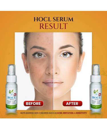 VoilaVe Pure Hypochlorous Acid Serum - Anti-Wrinkle Gel for Redness Irritation & Dark Circles | HOCL for Acne & Spots | 1.7 fl oz - International Shipping Available - Buy Online on SooperMarket.com