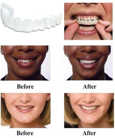 4 Pcs Fake Teeth Dentures for Women and Men - Temporary Dental Veneers for Natural, Comfortable Teeth Restoration, Protecting Your Smile - Buy Online on SooperMarket.com