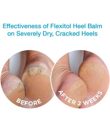 Flexitol Heel Balm 4 Oz Tube (Pack of 2) - Moisturizing Foot Cream for Rough & Cracked Heels/Feet. Diabetic Safe & Effective - 4 Ounce (Pack of 2) - Buy Online on SooperMarket.com
