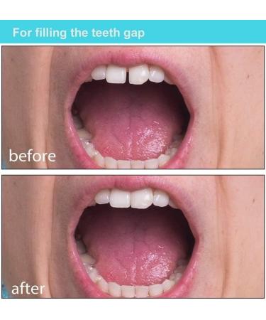 Fake Tooth Repair Kits for Filling The Missing Broken Tooth and Gaps-Moldable Fake Teeth and Thermal Beads Replacement Kits - Buy Online on SooperMarket.com